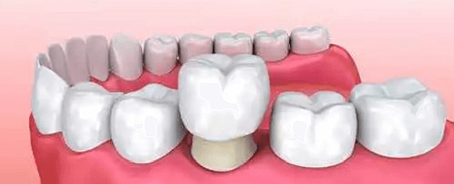 model de coronita dentara
