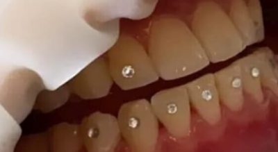 servicii de aplicare bijuterie dentara pe dinte servicii de aplicare bijuterie dentara pe dinte
